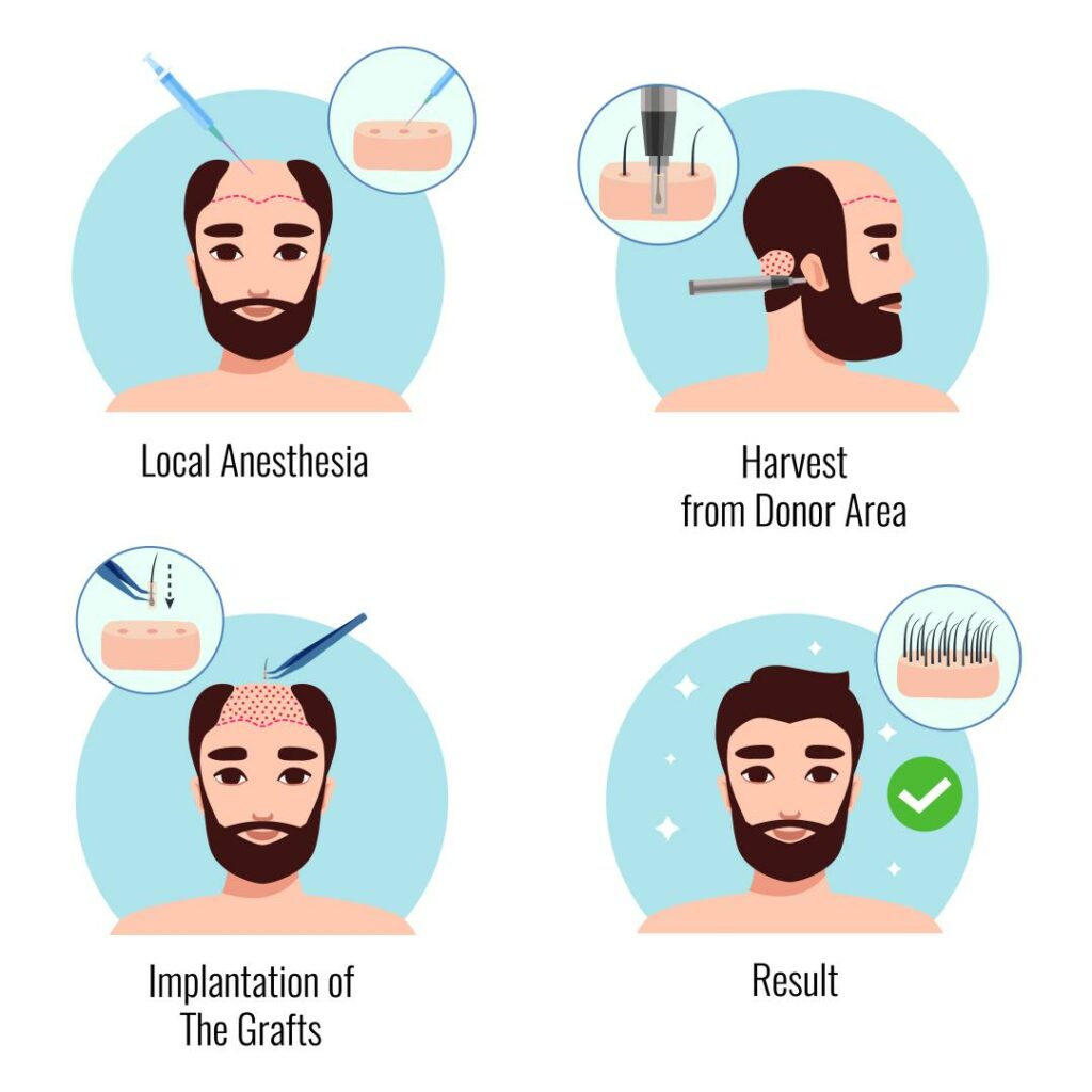 The Ultimate Guide to DHI Hair Transplant in Turkey 2023: Why Choose Turkey for Better Results