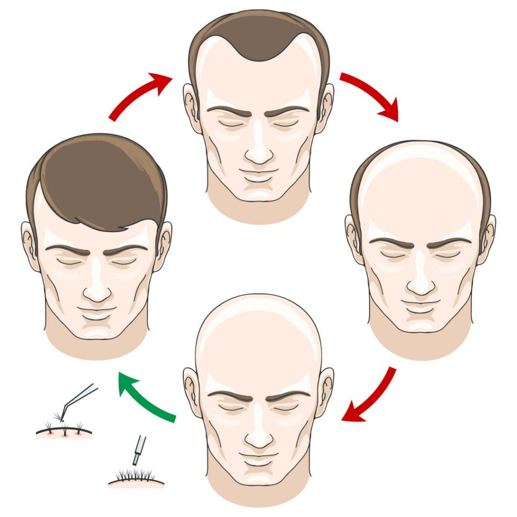 Does Hair Transplant Hurt? What to do for Painless Hair Transplant in 2023?