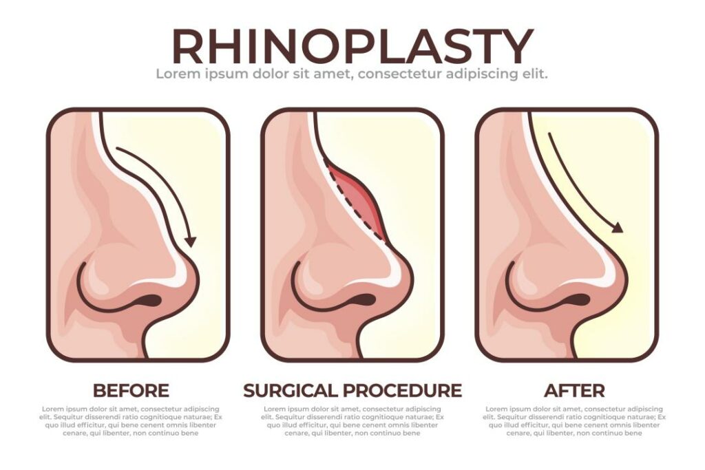 Discover the 7 Common Types of Noses: Why Rhinoplasty in Turkey is Better