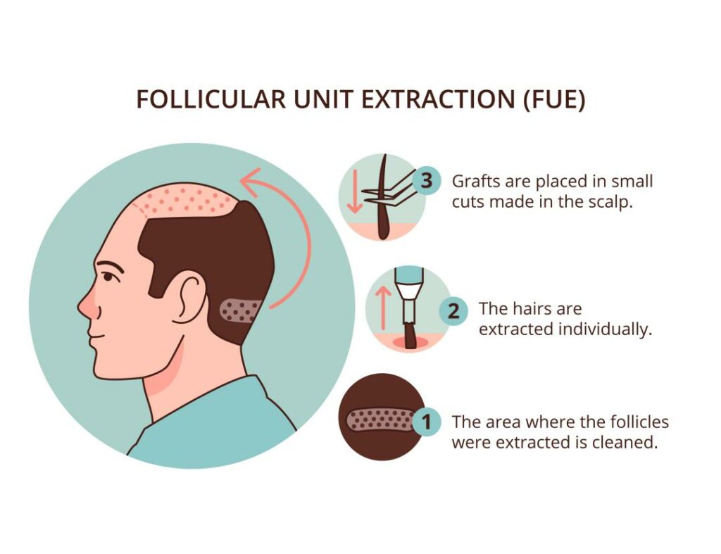 FUE Hair Transplant in Turkey: A Comprehensive Guide to Natural-Looking Hair Restoration 2023