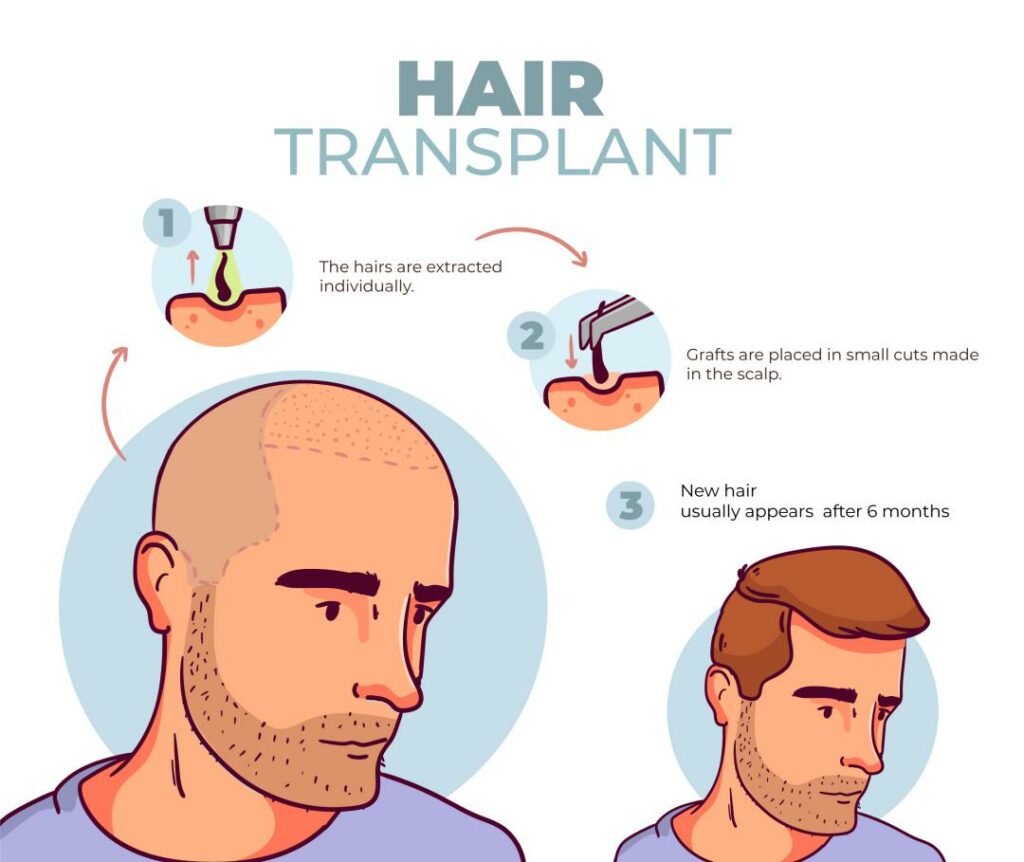 Healing After Hair Transplant Surgery in 2023: Tips for a Successful Recovery