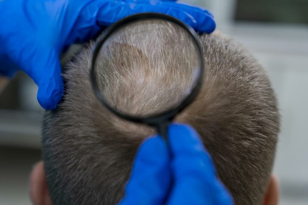 Does Hair Transplant Work in 2023? Understanding the Procedure and Results