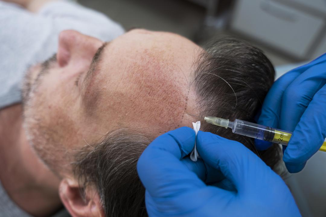 Does Hair Transplant Hurt? What to do for Painless Hair Transplant in 2023?