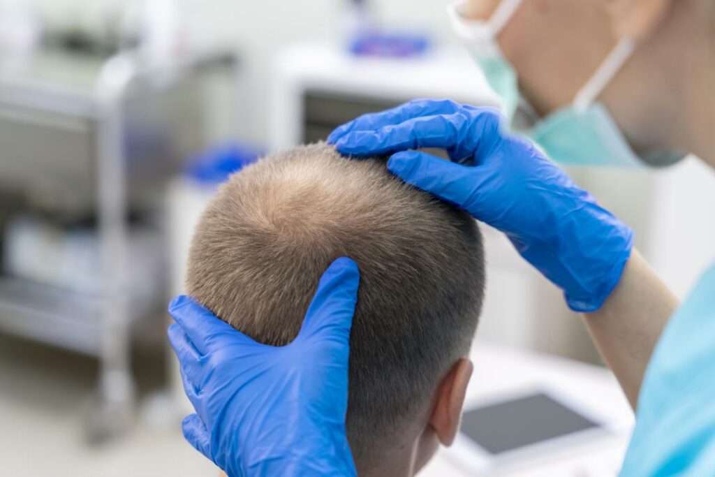 Why Hair Transplants in Turkey is Better 2023?