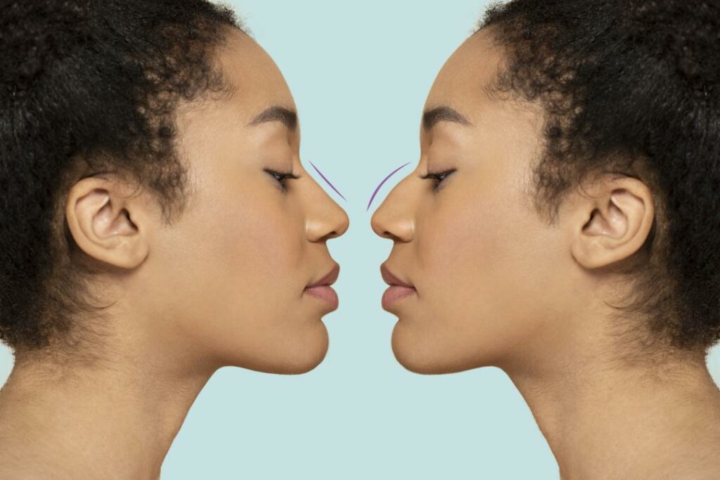 Discover the 7 Common Types of Noses: Why Rhinoplasty in Turkey is Better