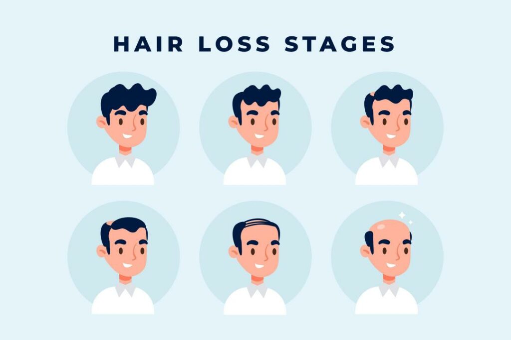 How to Become A Bald Man: A Comprehensive Guide About 7 Stages of Balding