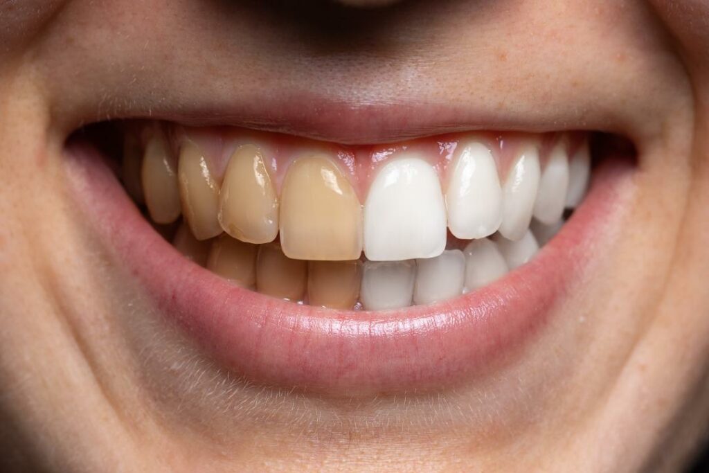 The Ultimate Guide on How to Get a White Tooth in 2023: Get a Dazzling Smile in Turkey