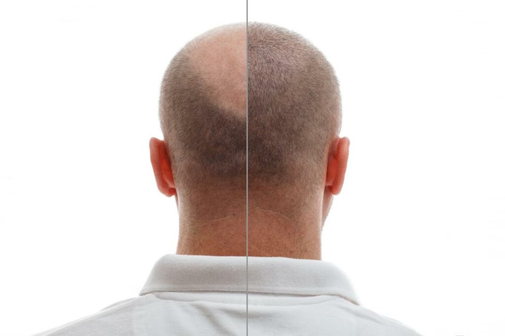 How to Become A Bald Man: A Comprehensive Guide About 7 Stages of Balding