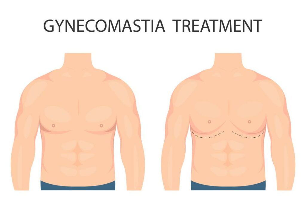 Gynecomastia Surgery in Turkey: A Comprehensive Guide to Top-Quality Treatment in 2023