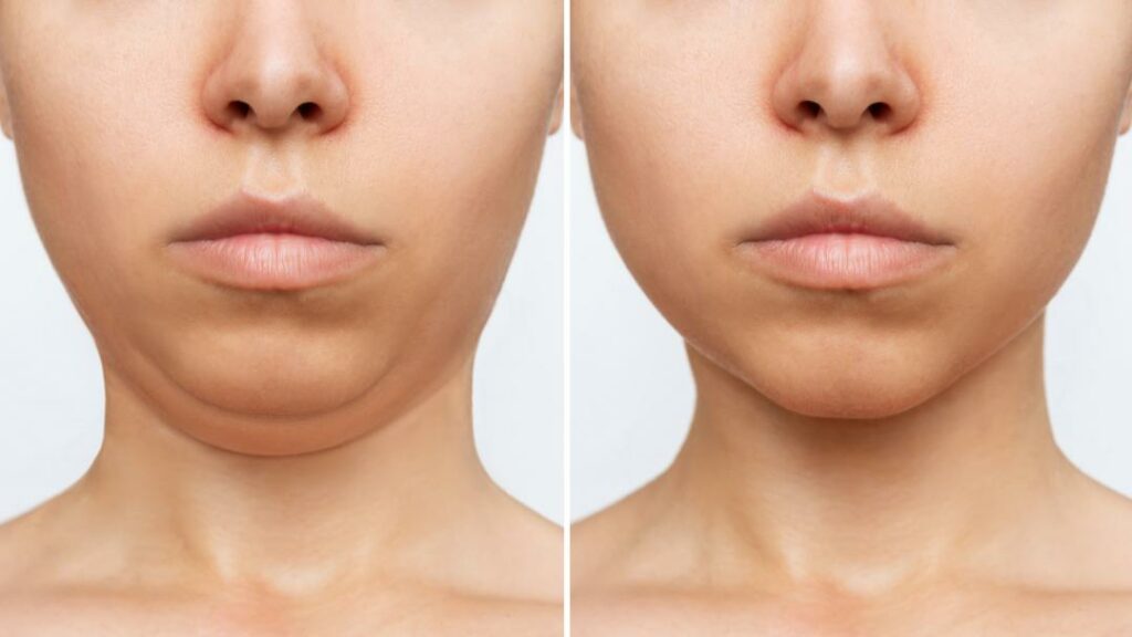 The Ultimate Guide to Chin Liposuction in Turkey: Your Path to a More Confident in 2023