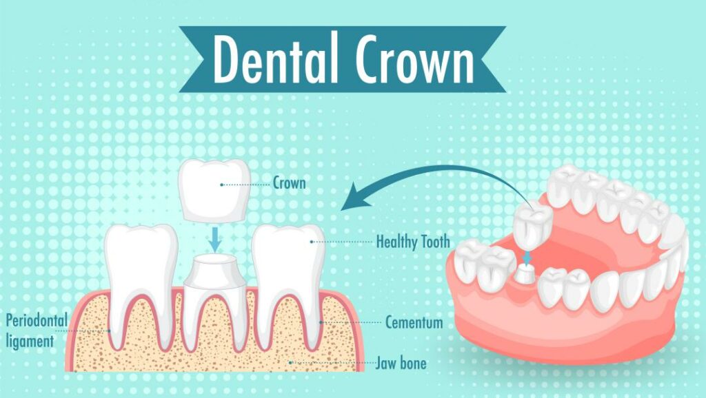 Sparkling Smiles and Affordable Care: Discover Silver Crowns in Turkey for Dental Tourism 2023