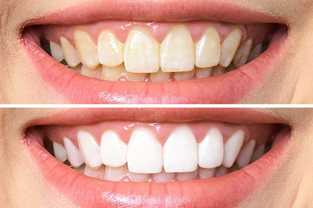 Unveiling the Mystery of White Spots on Teeth: Causes, Treatment 2023