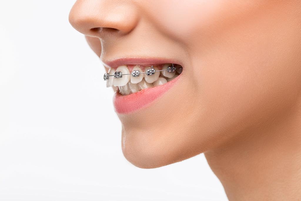 Straighten Your Smile with Orthodontic Treatments in Turkey 2023