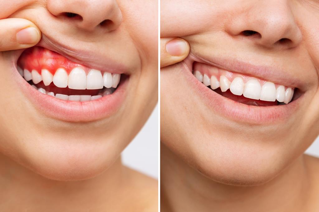 Unveiling Smiles: Discover the Path to Gum Disease Prevention and Treatment 2023