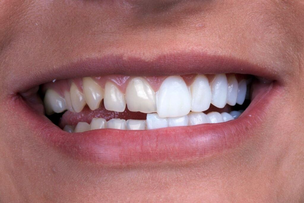 White Zirconium Crown Full Veneer